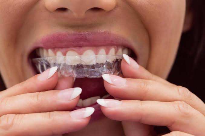 Invisalign Trinoma: Your Guide to Clear Aligner Treatment in Quezon City
